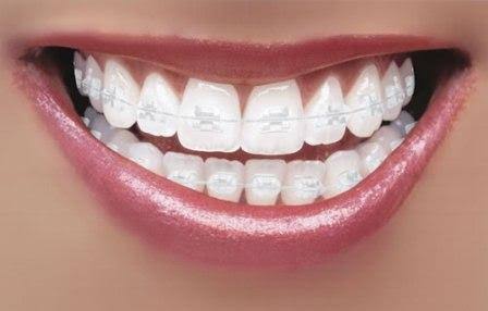 Ceramic braces