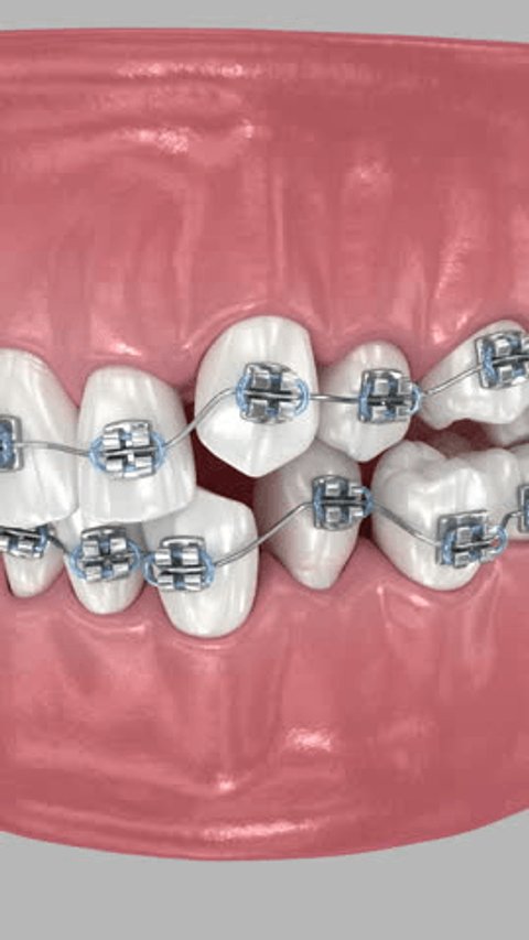 Metal braces