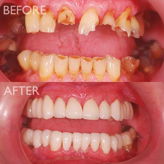 FMR = Full Mouth Rehabilitation